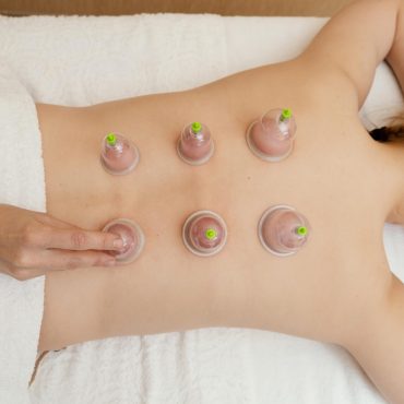 mulher-em-terapia-com-ventosas